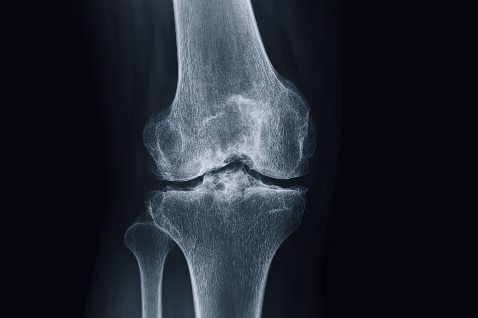 Radiology of Arthritis