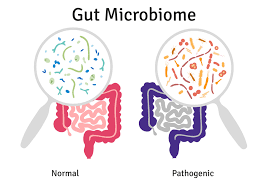 picture of intestinal dysbiosis