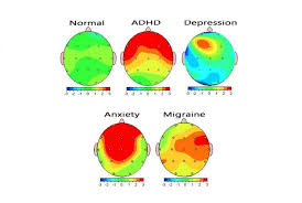 Brain mapping picture