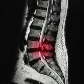 spinal stenosis pic