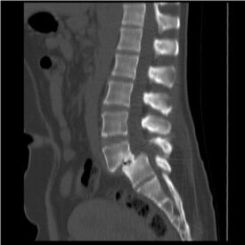 Pic of Spondylolisthesis