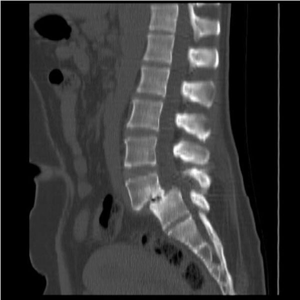 Pic of Spondylolisthesis