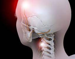 pic of cervicogenic headache