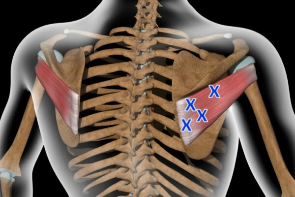 pic of trigger points of thoracic spine